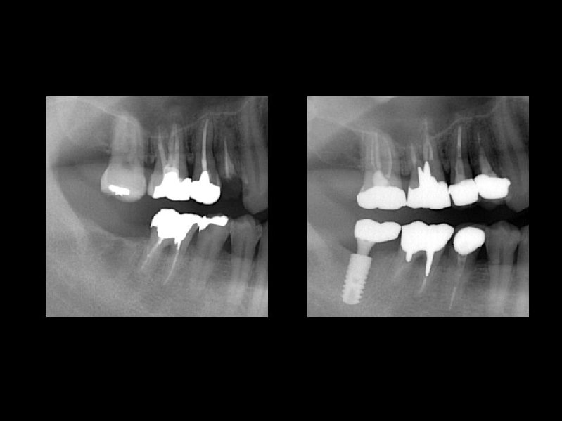 歯をこれ以上失わない予防的インプラント
